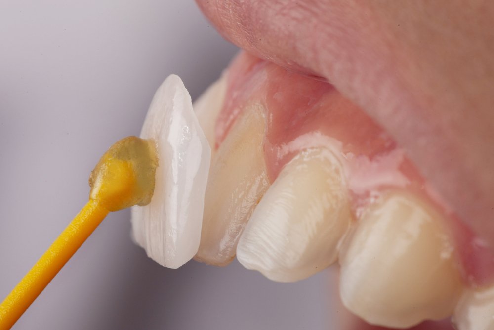 Porcelain Veneers Application - Complete Smile Transformation